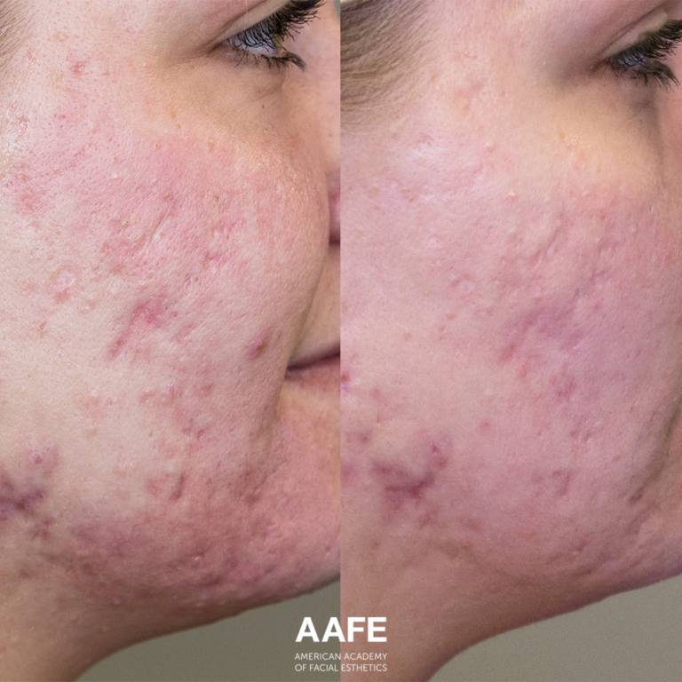 Acne Scarring - Smooth Threads