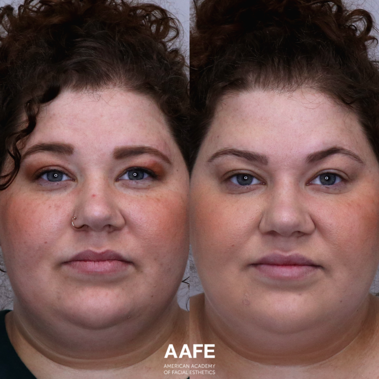 Brow Lift