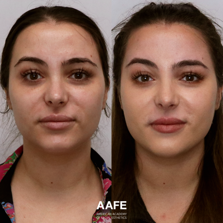 Brow Lift - Lifting Threads