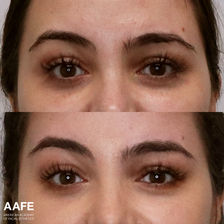 Brow Lift - Lifting Threads