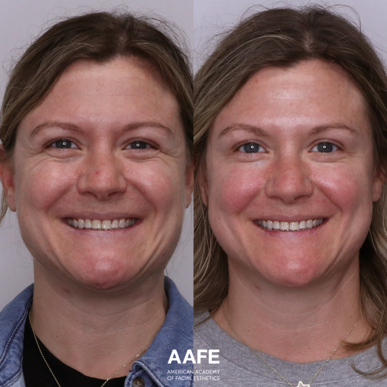 Full Face