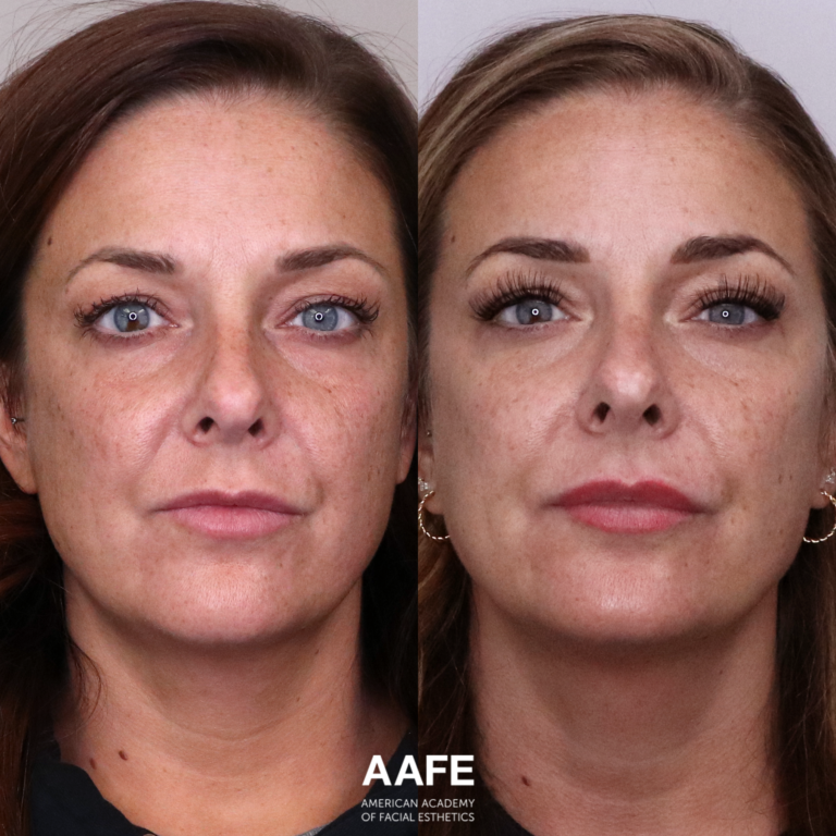 Nasolabial Folds