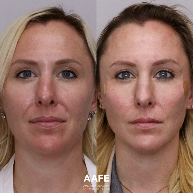 Nasolabial Folds - Lifting Threads