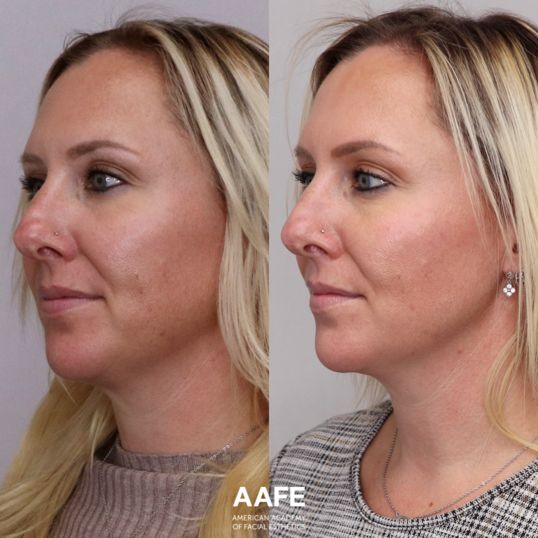 Neck Lift - Lifting Threads