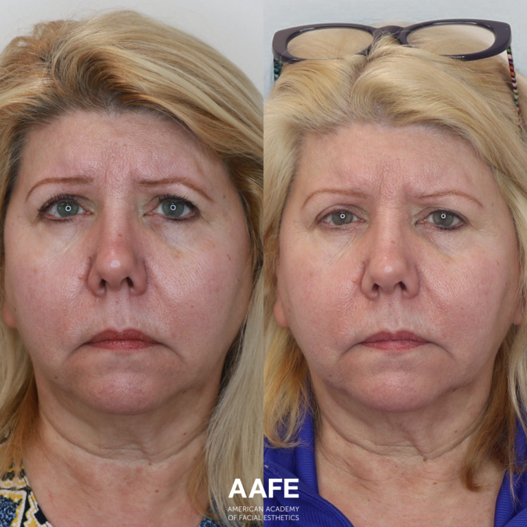 PRF - Microneedling