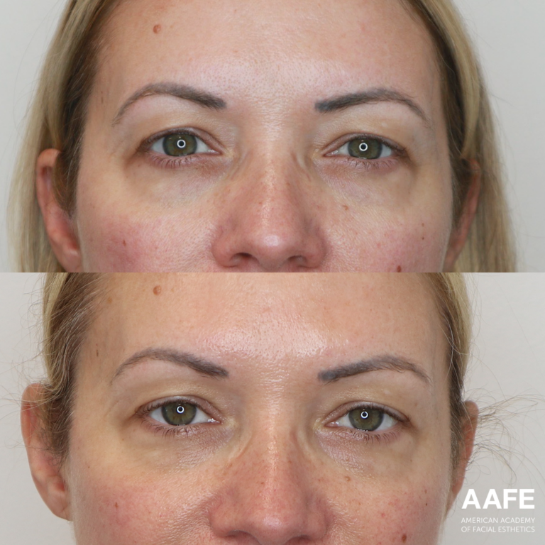 PRF - Undereye