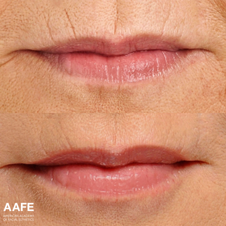 Radial Lip Lines