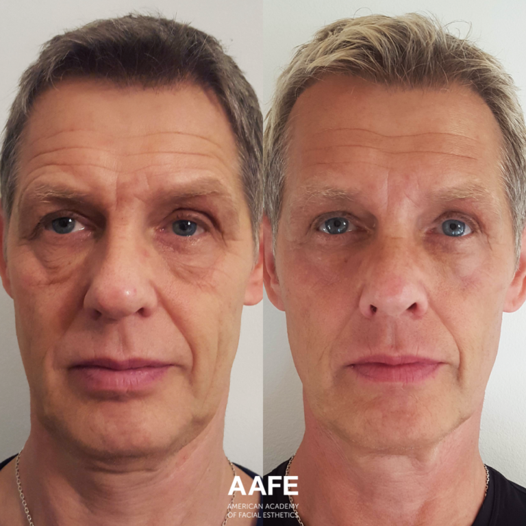 Under Eye - Smooth Threads